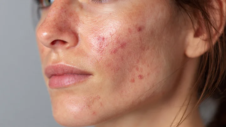 Close-up of inflamed skin showing red spots, pimples, and irritation - targeting issues with anti-inflammatory skin care